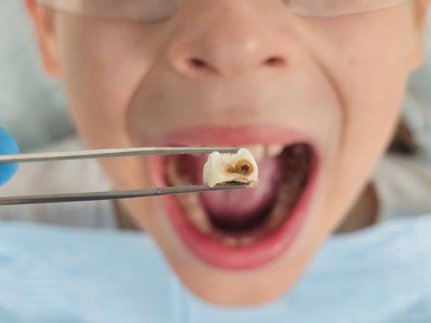 Best Emergency Root Canal Treatment in Lockeford, CA