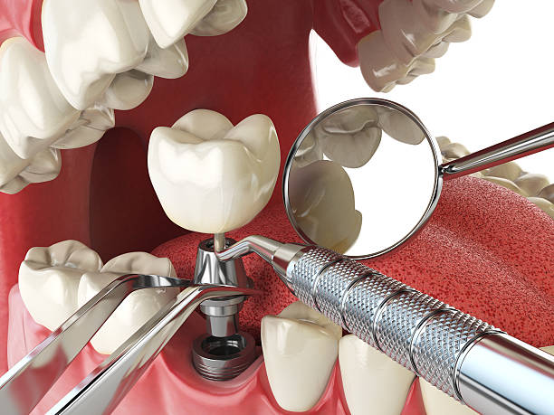 Best Emergency Tooth Extraction in Lockeford, CA